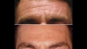 wrinkles